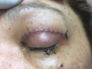 eyelid-surgery
