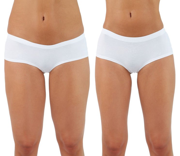 Tumescent liposuction is the safest form of liposuction