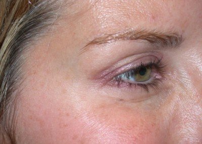Botox After Eye