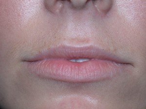 LipsBefore1