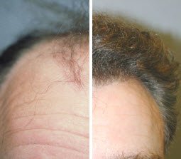Our hair restoration services are great