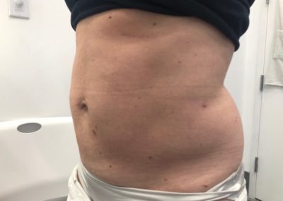 After Vaser Lipo Midsection